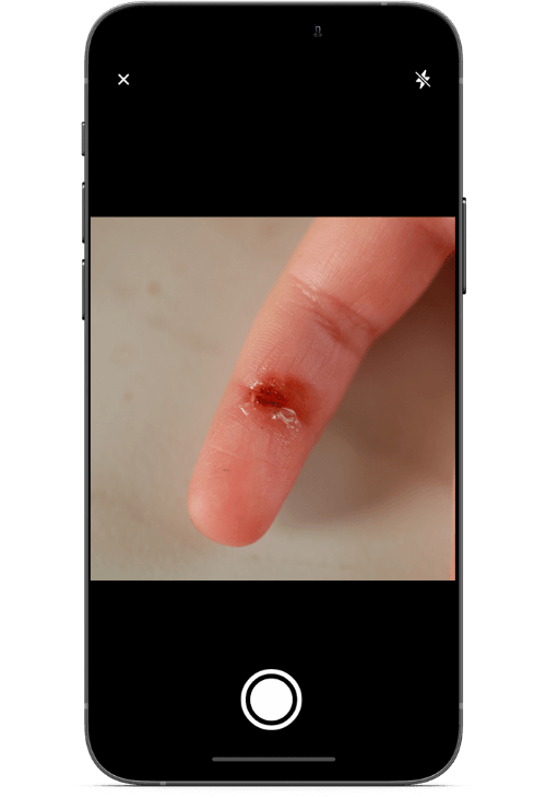 Un dedo con una quemadura en cámara